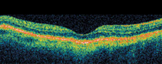 Picture: Illustration of anatomy of an eye with wet AMD, identifying the lens, retina, abnormal leaky blood vessels and increased VEGF-A
