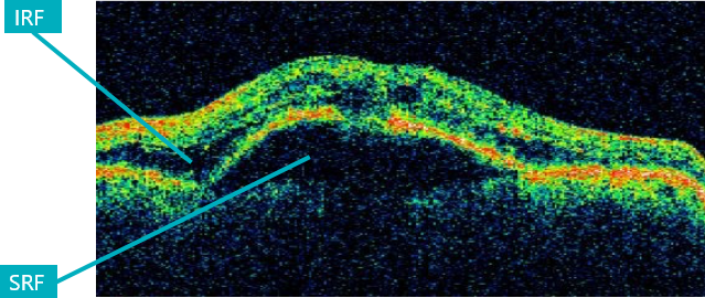 Picture: Illustration of anatomy of an eye with wet AMD, identifying the lens, retina, abnormal leaky blood vessels and increased VEGF-A