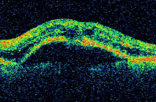 Picture: O.C.T. scan of retina with fluid